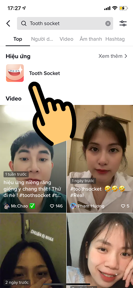 Hiệu ứng niềng răng Tooth socket Hiệu ứng niềng răng Tooth socket