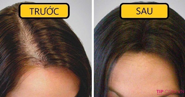 Điều trị rụng tóc hiệu quả nhất 2020