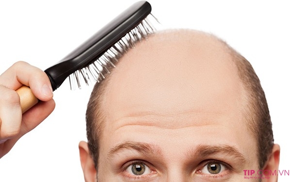 Rụng tóc androgenetic là gì?