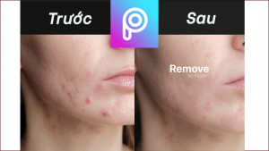 app xoá mụn
